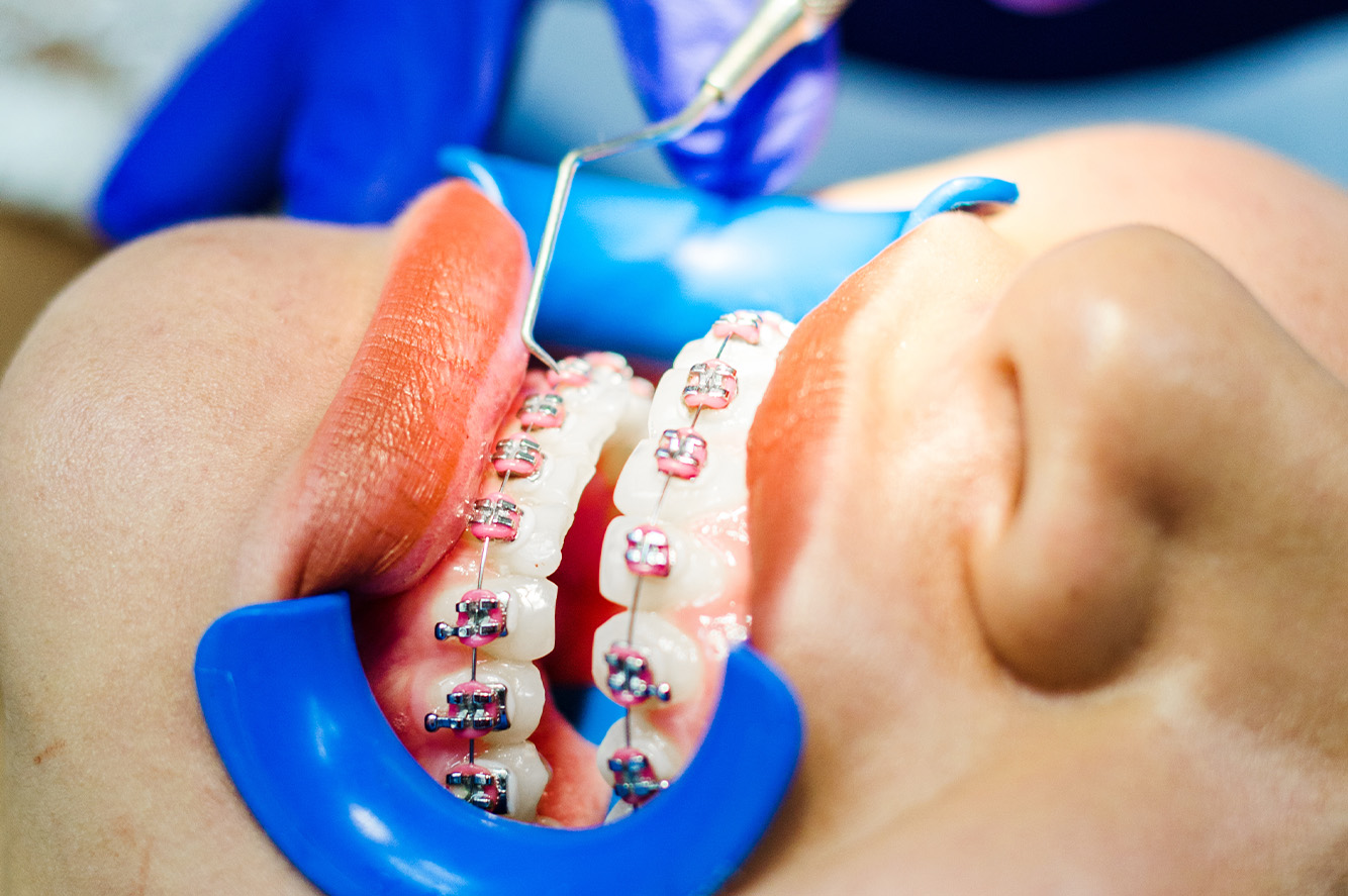Imagen para Precios y Tipos de Ortodoncia en Quito