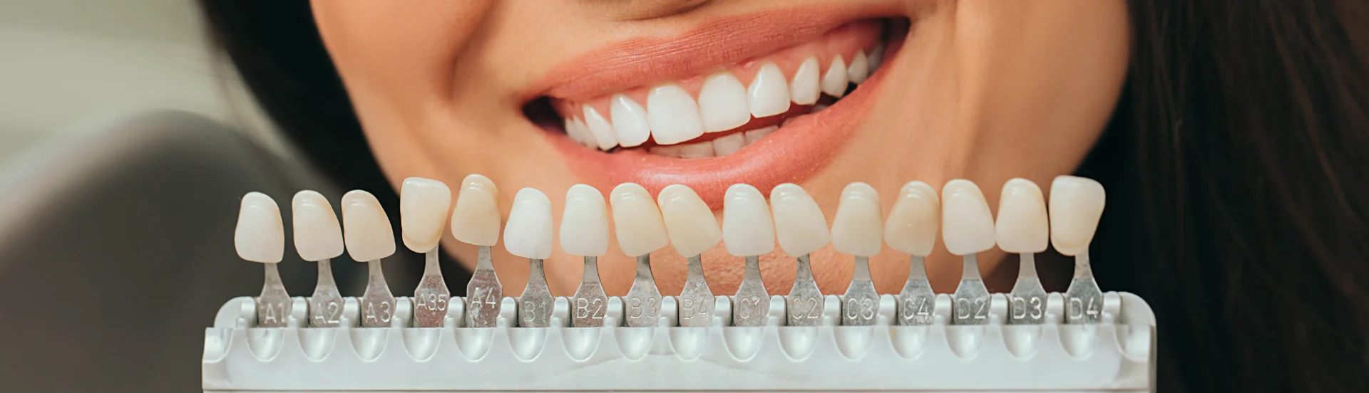 Precios de carillas dentales en QuitoPrecios de las Carillas Dentales en Quitobanner