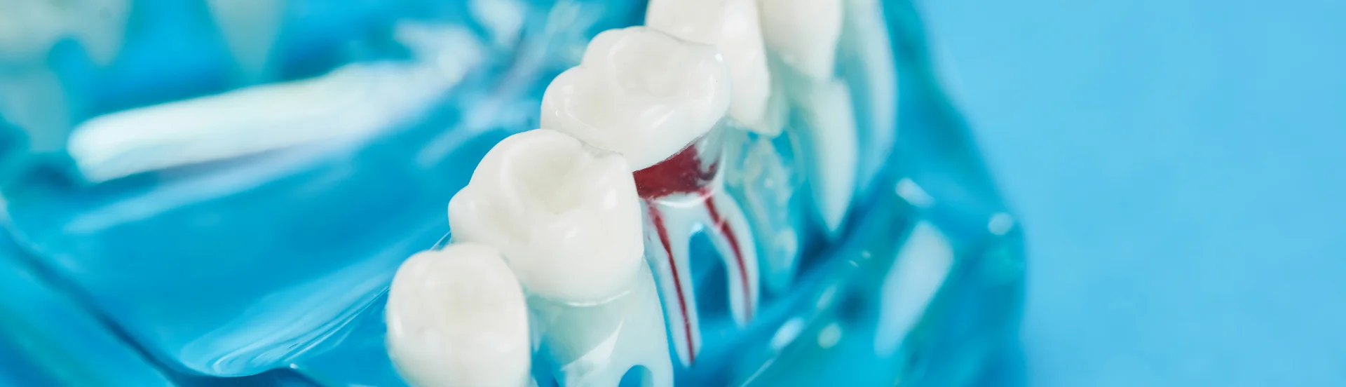 Endodoncia en Ecuador con Depau clinica dental¿Cuánto cuesta una endodoncia en Ecuador? Guía 2026banner