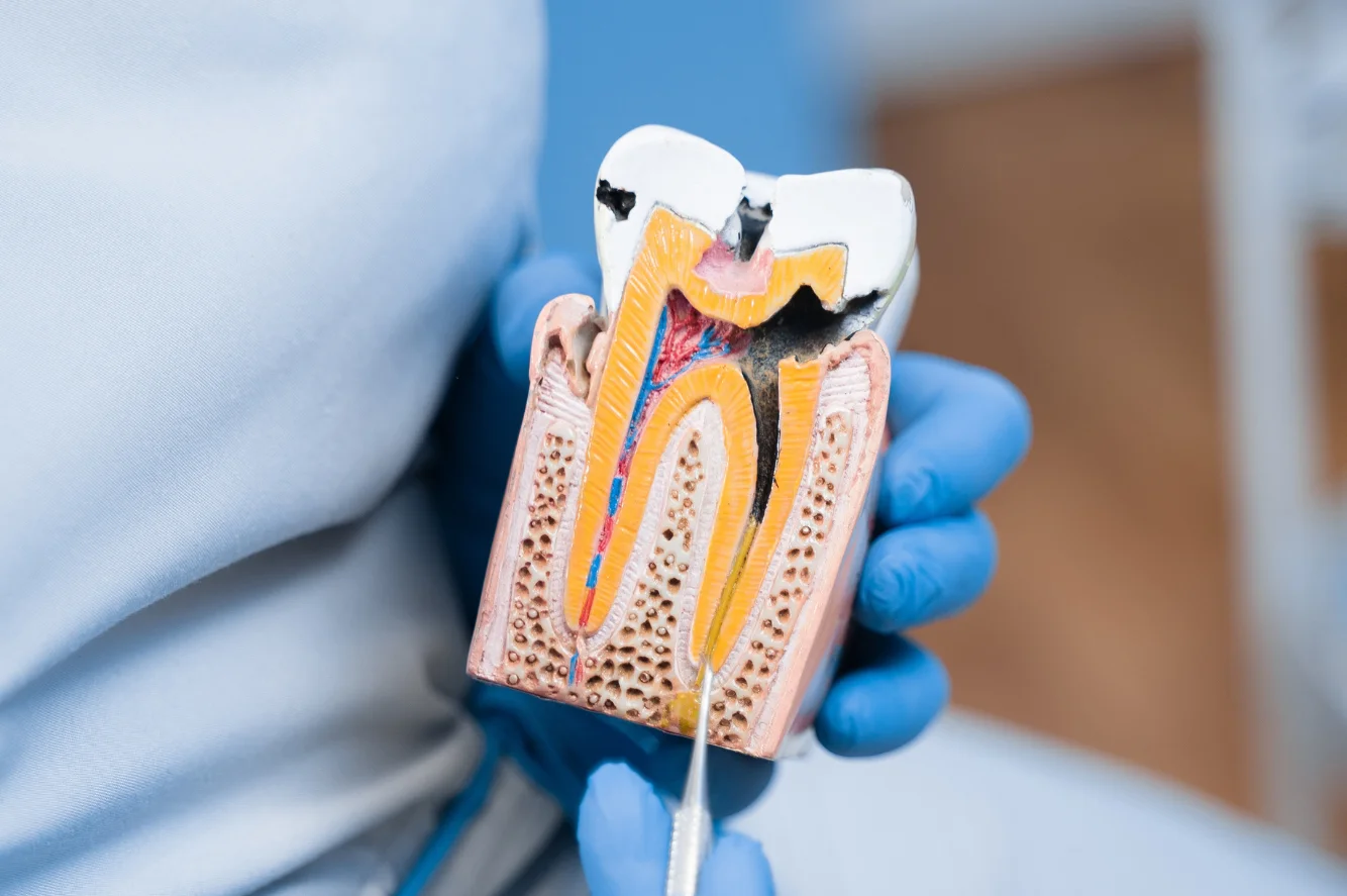 Imagen para ¿Cuánto cuesta una endodoncia en Ecuador? Guía 2026