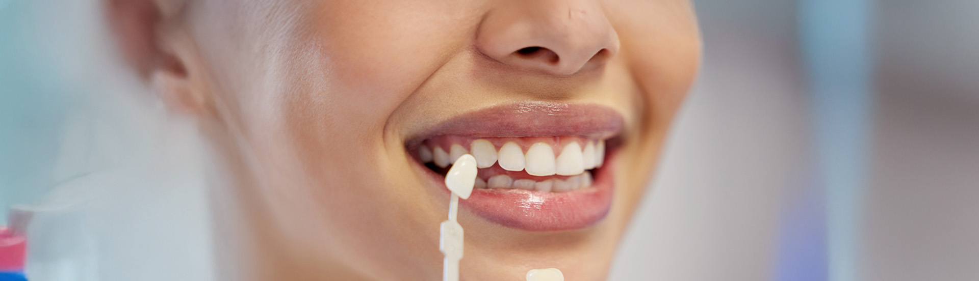 Precios de carillas dentales en QuitoPrecios de las Carillas Dentales en Quitobanner