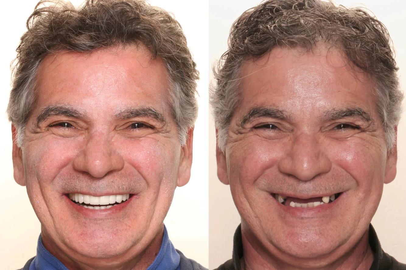 Imagen para ¿Cuándo ponerte implantes dentales en Quito? | Blog