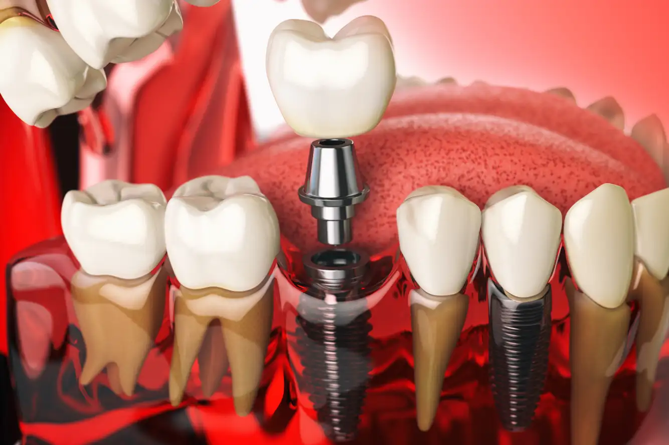 Imagen para Referentes de la implantología dental en Ecuador
